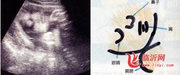 怀孕31周胎儿B超